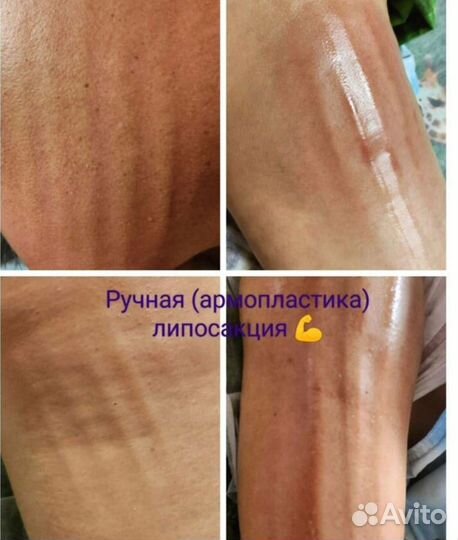 Массаж тела и лица / Ручная Липопластика