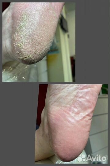 Лечебный педикюр подолог