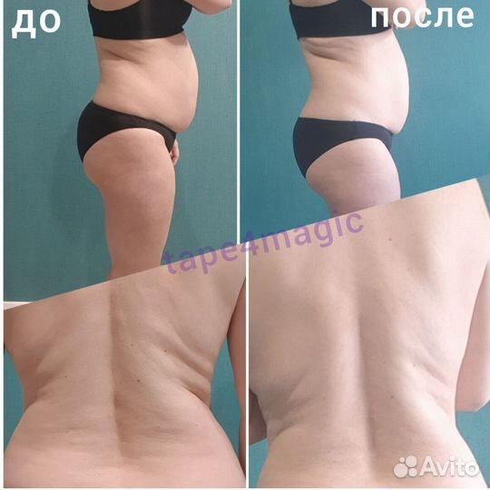 Эстетическое тейпирование. Коррекция фигуры