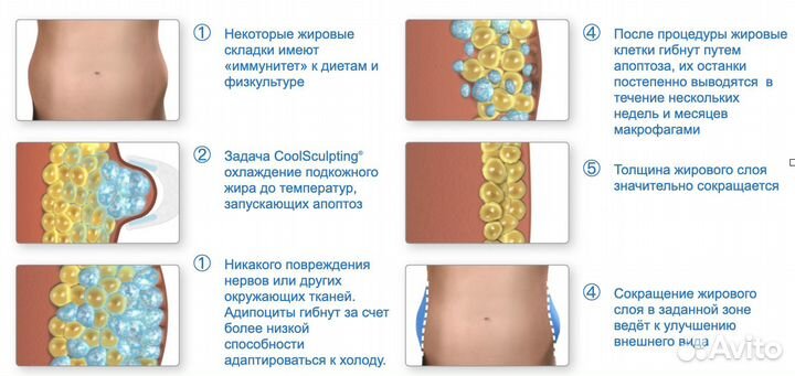 Криолиполиз в Муроме. Худеем без диет и тренировок