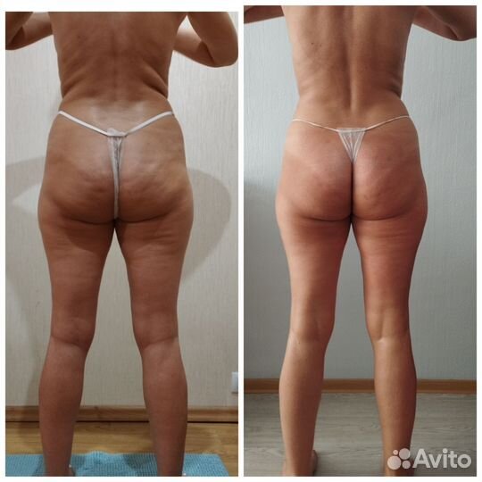 Массаж, антицеллюлитный массаж