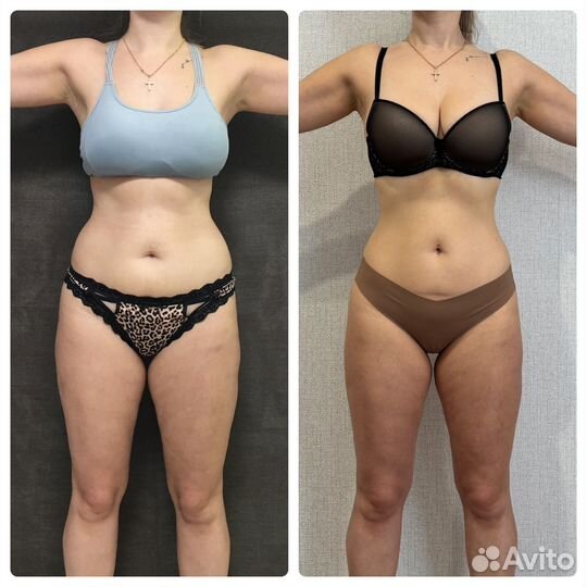 Антицеллюлитный массаж