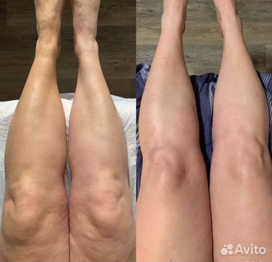Антицеллюлитный массаж