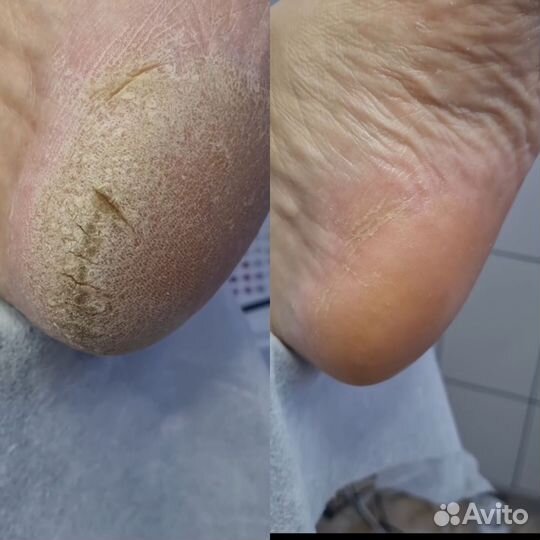 Подолог. Педикюр проблемной стопы