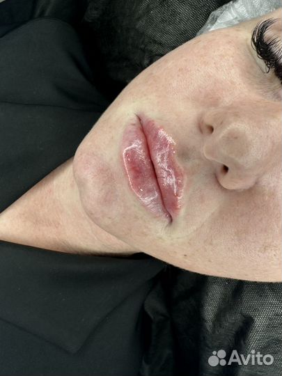 Увеличение губ