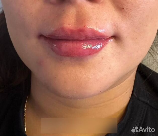 Увеличение губ