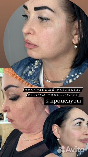 Липолитики по лицу