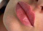 Ищу модель на увеличение губ(контурная пластика)