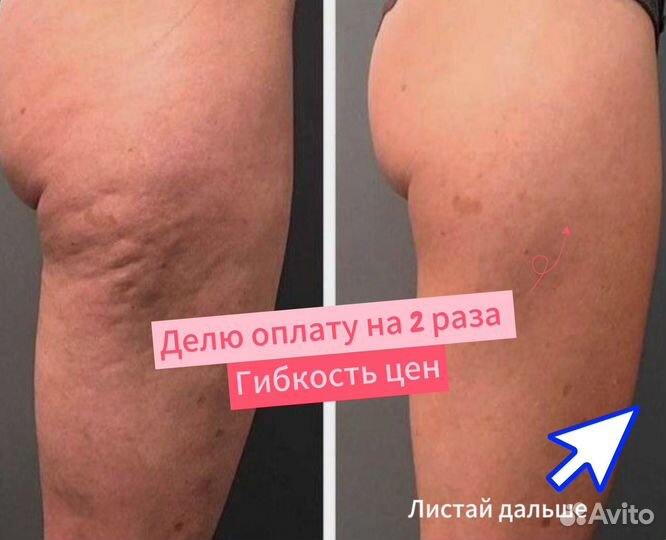 Антицеллюлитный массаж