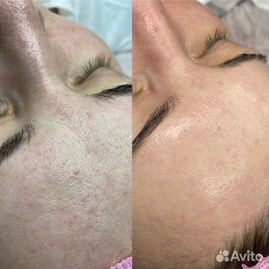 Косметолог чистка лица пилинг лица массаж