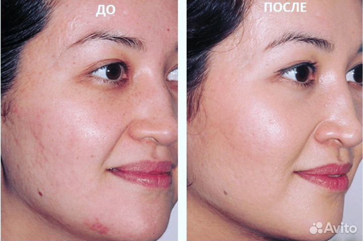 Лифтинг RF, кавитация, микротоки, миостимуляция