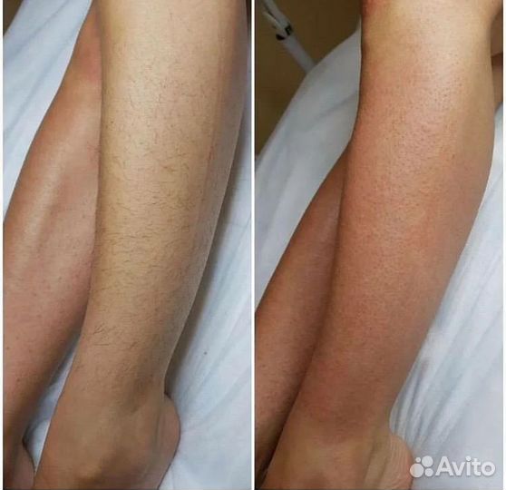 Восковая депиляция и шугаринг