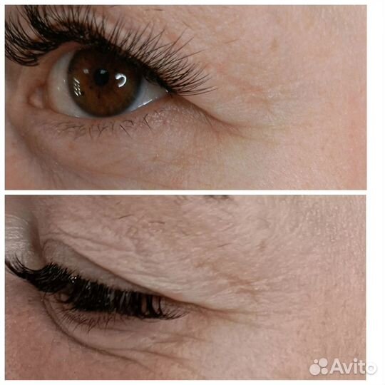 Смас лица, тела, подтяжка фигуры