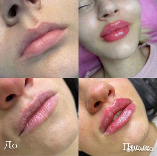 Увеличение губ