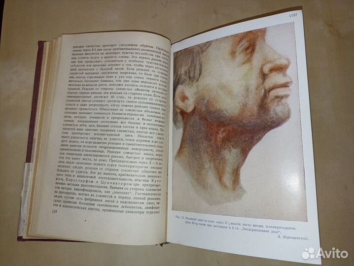 Злокачественные опухоли глоточного кольца. 1933