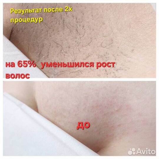 Лазерная эпиляция