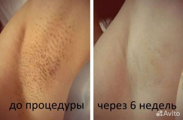 Лазерная эпиляция