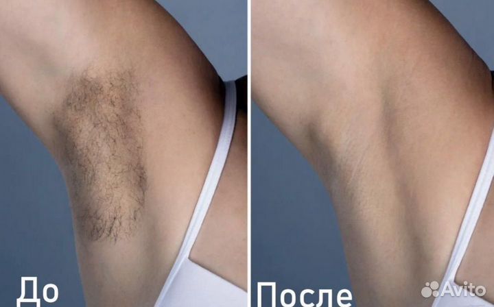 Шугаринг депиляция