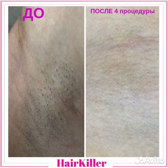 Лазерная эпиляция. Диодный лазер. Медобразование