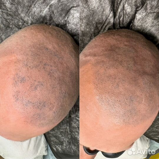 Выведение тату