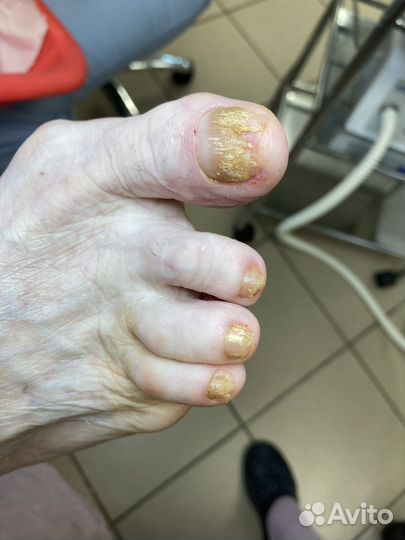 Педикюр, подолог,вросший ноготь, трещины,мозоли