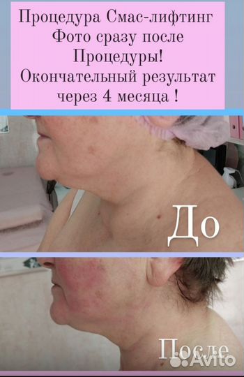 СМАС лифтинг подтяжка лица