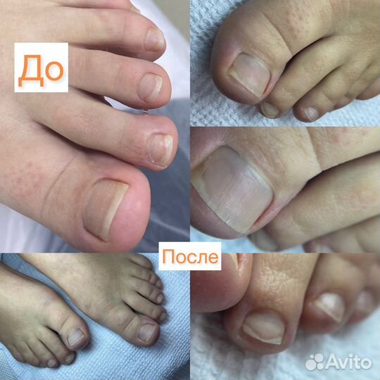 Медицинский педикюр. Подолог