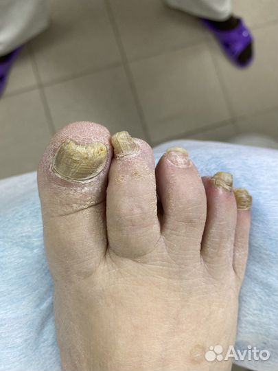 Подолог/Педикюр/Вросший ноготь/Мозоль