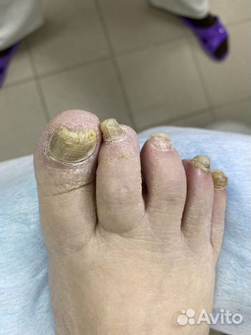 Подолог/Педикюр/Вросший ноготь/Мозоль