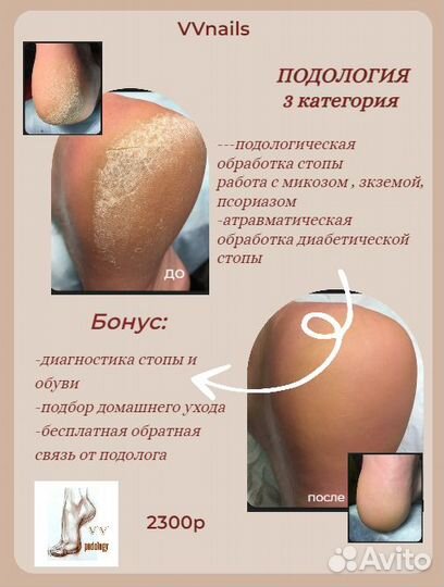 Лечебный педикюр подолог