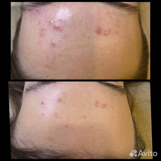 Косметолог, чистка лица, пилинг,омоложение