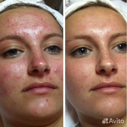 Забудьте про прыщи. Акне, постакне, лечение