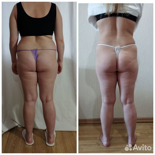 Массаж, антицеллюлитный массаж