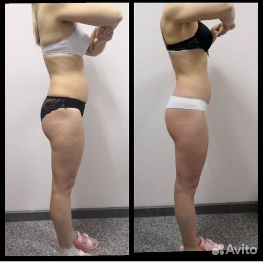 Аппаратный массаж LPG