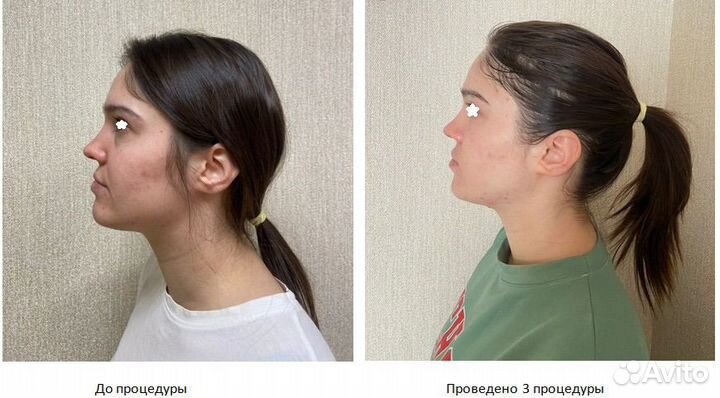 Ручная пластика лица