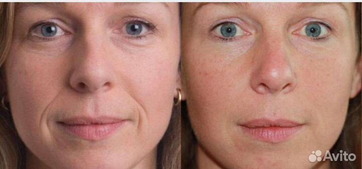 Скульптурный массаж лица