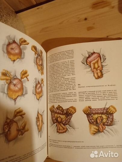 Оэперативная Хирургия и Топографическая Анатомия