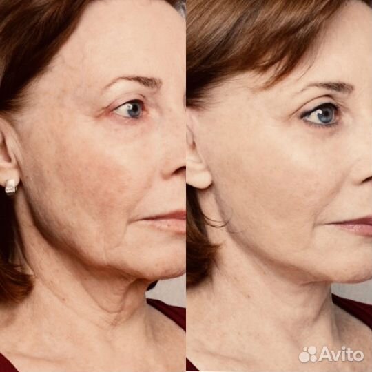 Массаж лица. Лифтинг лица без операций и инъекций