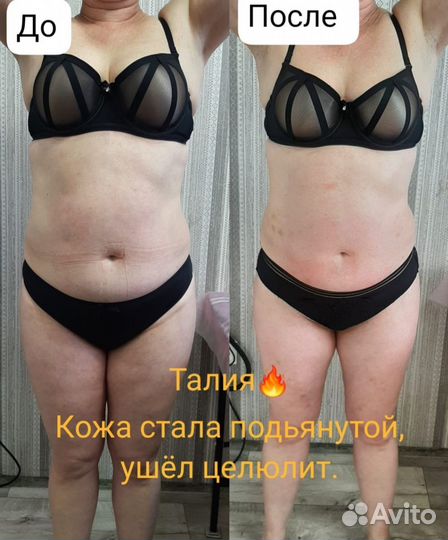 Аппаратный антицеллюлитный массаж