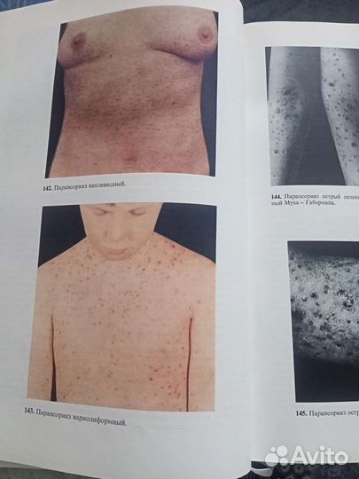 Атлас кожные и венерические болезни