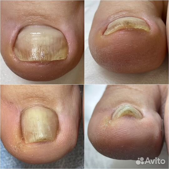 Подолог, вросший ноготь, грибок, мозоли, Липецк