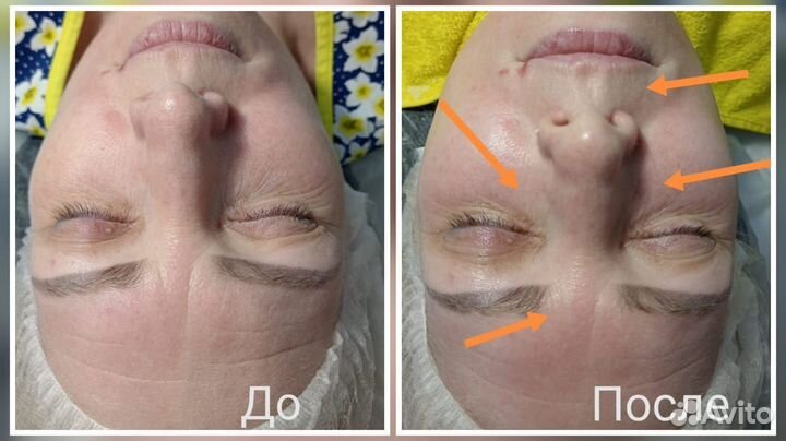 Элос - омоложение, эпиляция, чистка лица