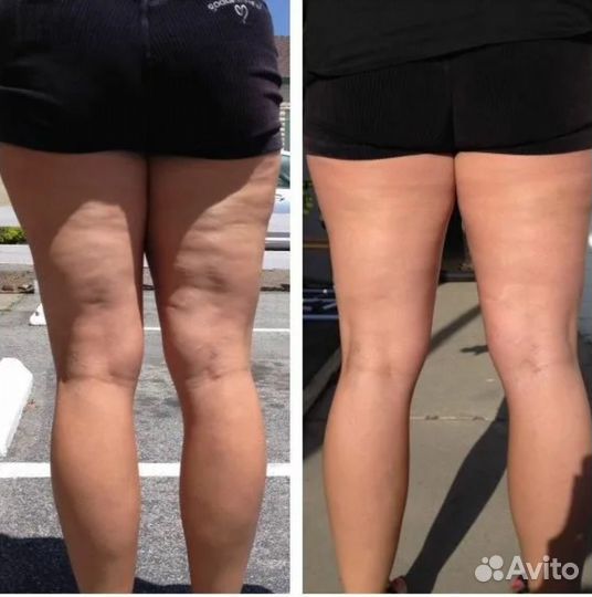 Антицеллюлитная маска скраб для стройности