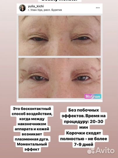 Холодная плазма Plasma Beauty Monster