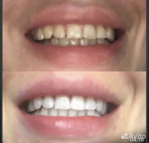 Гаджет для отбеливания зубов