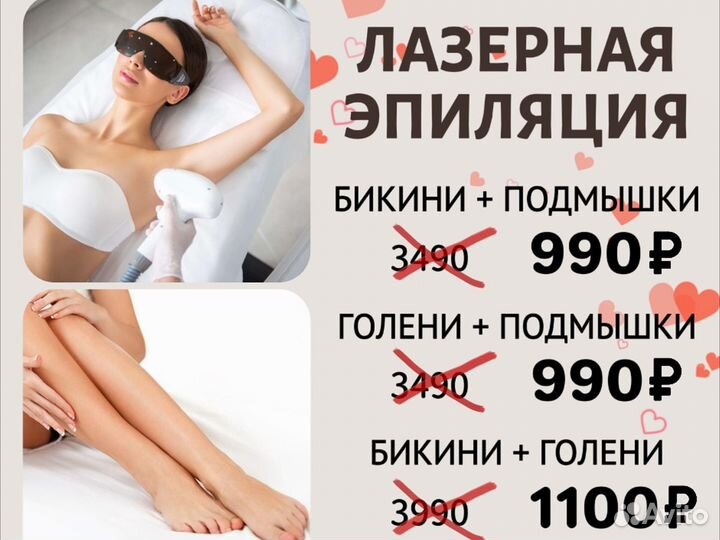 Лазерная эпиляция