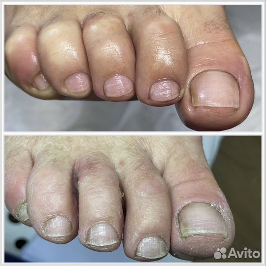 Подологический педикюр