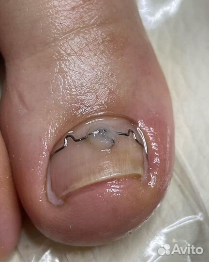 Педикюр подолог