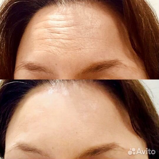 Массаж лица. Лифтинг лица без операций и инъекций