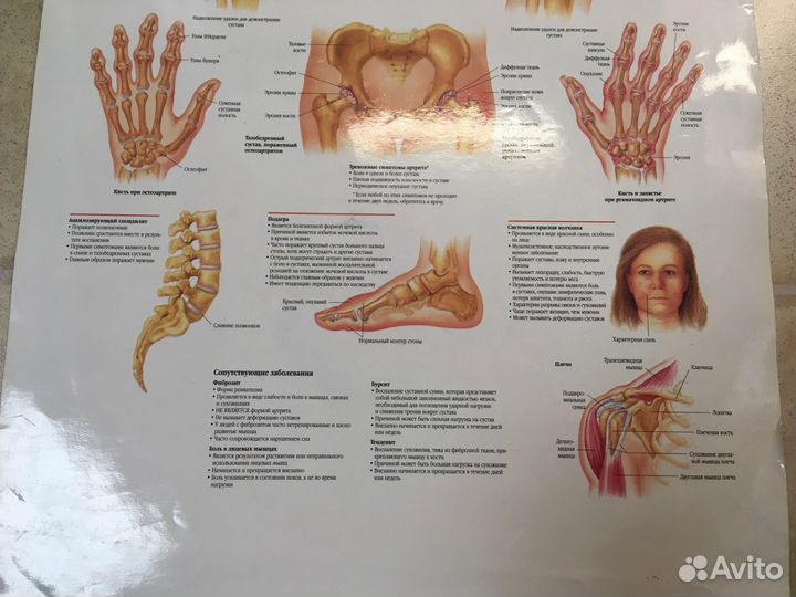 Плакат медицинский артрит 2 стороны